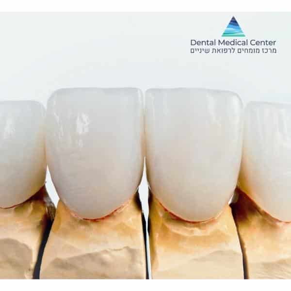 כמה עולה ציפוי חרסינה לשיניים דנטל מדיקל סנטר