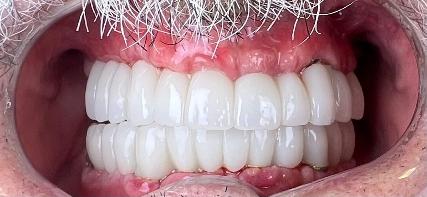  השתלת שיניים אחרי - dental medical center בהולת ד''ר דורון בר חן 
